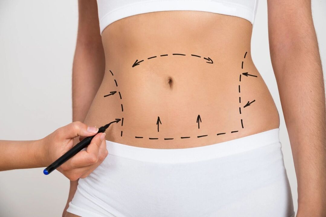 Marking on the abdomen before liposuction, figure correction